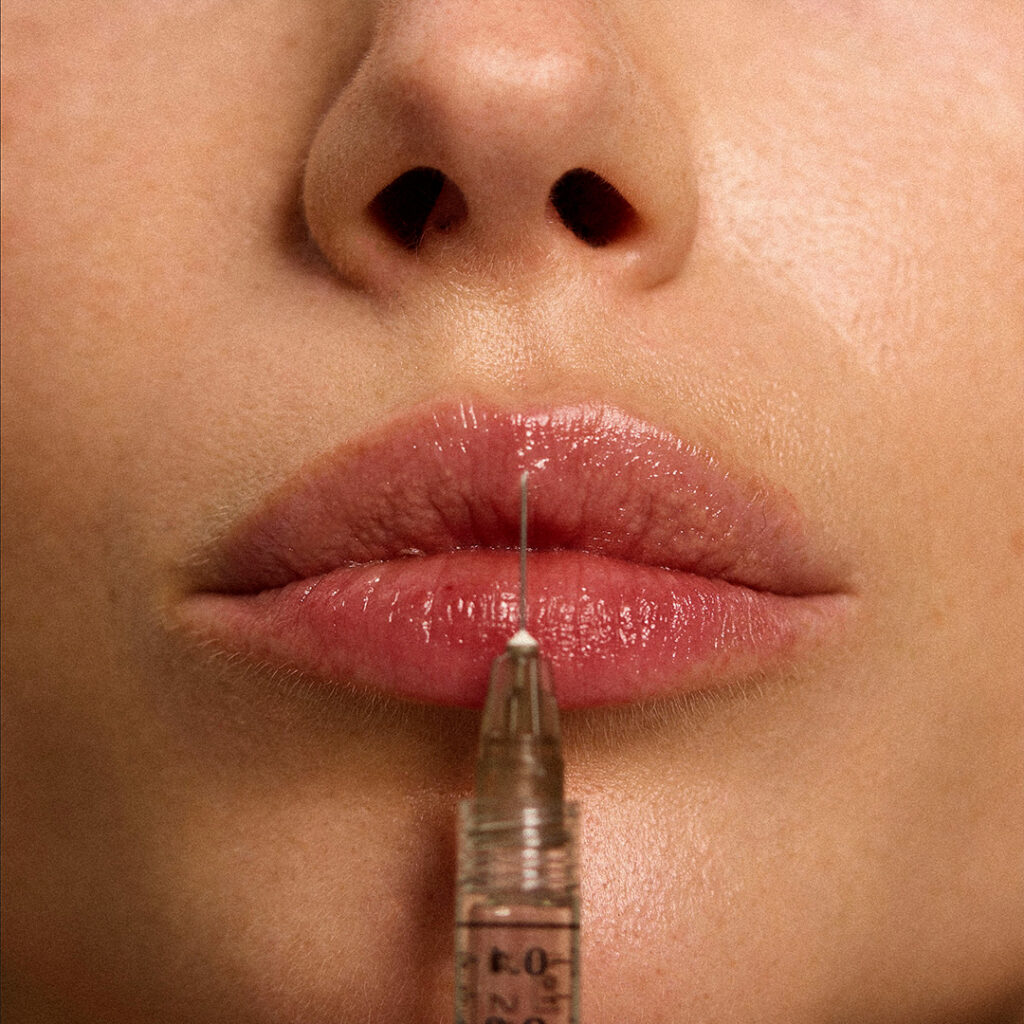 Lip Flip vs Filler – volle Lippen einer jungen Frau mit Injektionsnadel
